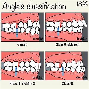 Dentalish On Instagram Quot Angle S Classification Angleの分類 Angleの分類
