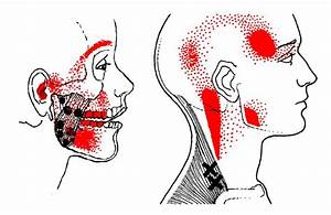 9 Best Tmj Headache Images On Pinterest Anatomy And
