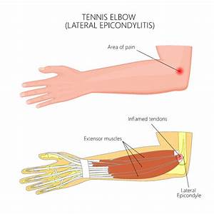 Aufregung Bewusst Lernen Tennis Elbow Surgery Procedure Bekenntnis