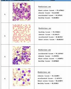 phase classification of chronic myeloid leukemia using convolution