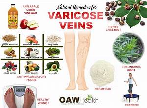 Varicose Veins What You Need To Know Oawhealth