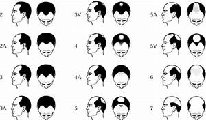 Dht How Does It Cause Hereditary Hair Loss The Hair Growth Specialist