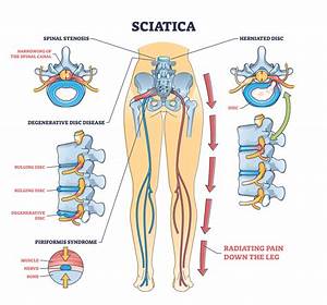 What Is Sciatica Types Of Sciatica Treatment Premia Spine Blog