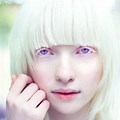 Albino Human Violet Eyes