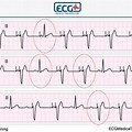 Paced Rhythm EKG