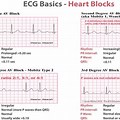 Heart Blocks Practice