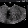 Large Uterine Fibroid