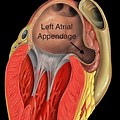Atrial Appendage T… 