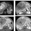 Liver Metastasis CT Contrast