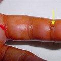 For Finger Infections