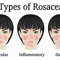 Rosacea Medication