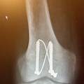 Fracture Fixation