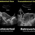 Retroverted Uterus