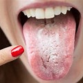 Tongue Symptoms