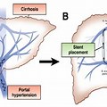 Hepatic Encephalopa… 