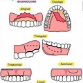 Types of Flaps in Dentistry