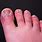 Chilblains On Toes