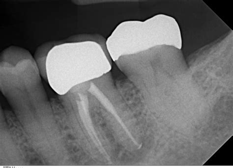 Is the Cost of Root Canal Through Crown Worth It?