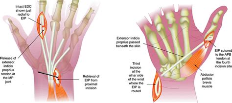 Tendon Transfer