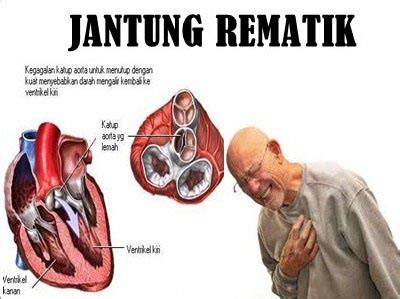 penyakit jantung rematik