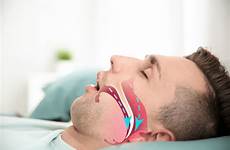 sleep apnea obstructive treating diagnosing osa do breathing disorder sleeping dentist dentistry