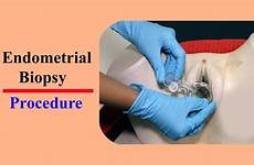 biopsy endometrial cervical endometriosis ablation uterus abla pinnwand auswählen