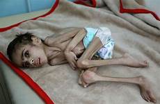 malnourished yemen yemeni malnutrition cerebral faid palsy weighs ravaged samim blockade tragic sanaa usnews