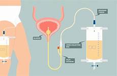 catheter foley urine cancer into draining