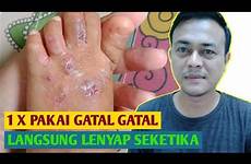 gatal berair kulit badan obat seluruh sembuh