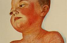 fever scarlet children 1911 shelmerdine mccombs diseases nurses fig robert internet depiction literature letters archive
