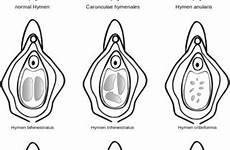 hymen tissue visual introitus suggests consistent representation configurations source