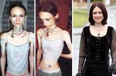 anorexia anoressia anorexic pessoas venceram guarigione struggle became shelton