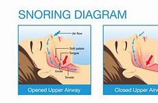 snoring night apnea
