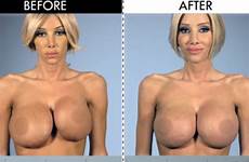 implants augmentation kimber boobs