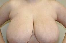 reduction breast
