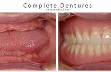 dentures complete before after denture seattle services