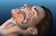 sleep apnea surgery obstructive airways virtuosa upper virtual treatment solutions sintef breathing during person