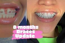 braces gap