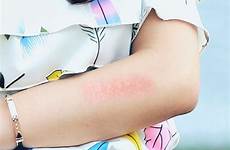 allergy allergic skin symptom pixabay