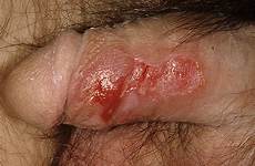 genital herpes male symptoms show gonorrhea chlamydia hsv signs slideshow