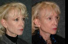 65 old year face woman lift natural eye reviews