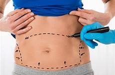 liposuction vs coolsculpting lipo body difference fat sites procedure