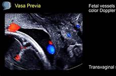 vasa previa ultrasound diagnosis