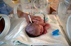 premature infants means percent dying reversal nicus 1960s