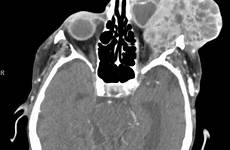 lacrimal gland cystic ct adenoid carcinoma maxillofacial imaging coronal bone orbital repeat performed left mass cases remodeling
