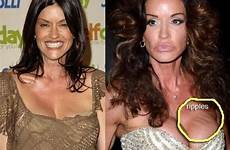 surgery plastic before after boob janice dickinson celebrity botched breast implants bad worst jobs job good duck celeb wrong gone