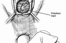 vaginal rectovaginal repair fistulas colorectal jcm illustration treatment anatomical surgical demonstrating technique low figure mdpi imaging novel interventional modalities