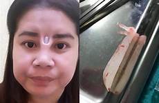 botched operasi plastik implant hidung gagal wanita protruding atas berlubang bagian rhinoplasty apes sisi gelap bergidik kena pengen mancung malah