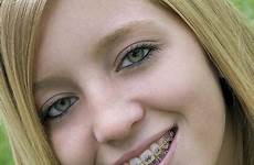 braces girl 2010 concord portrait teeth