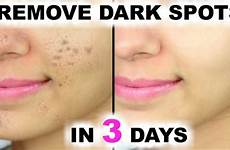 acne scars blemishes remedies marks pimple remover reduce overnight potato artsycraftsydad maxdio picturefeast jessica